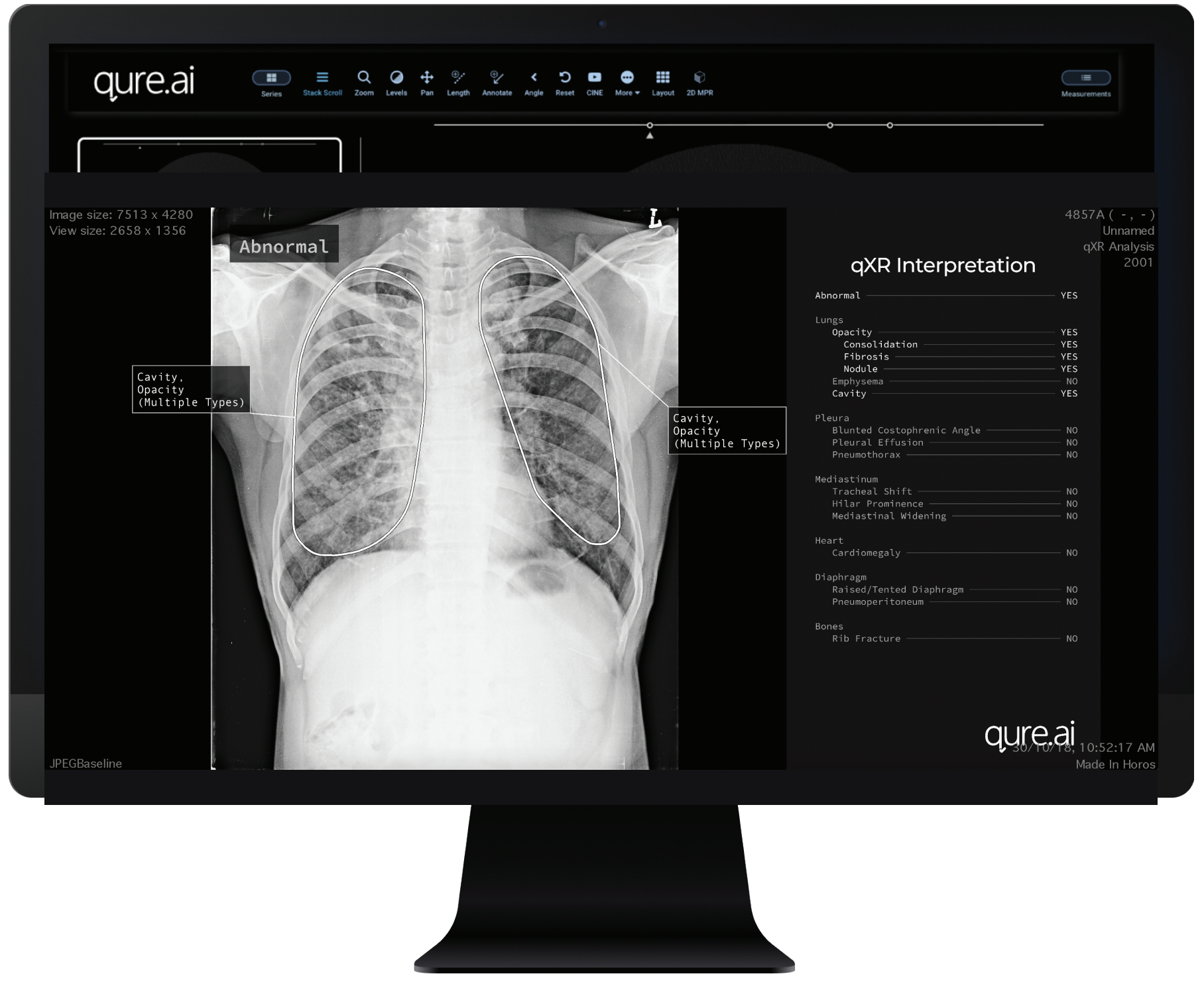 Qure.ai's CE-certified chest X-ray solution, qXR, will help identify which cases are clear of clinically relevant findings, allowing radiologists to detect them even before they open the case.